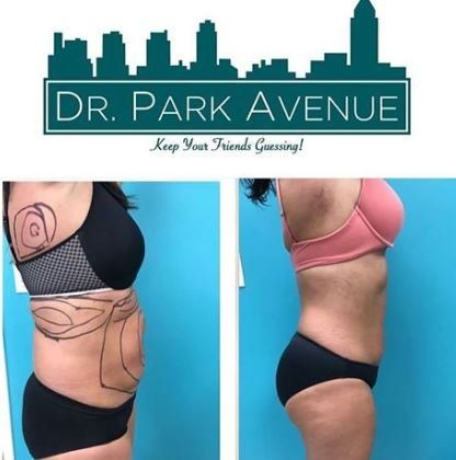 Before and after body contouring. Woman's side profile, surgery markings on the left. Pink bra, black underwear.