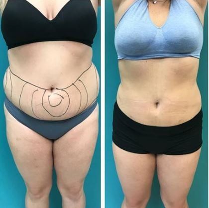 Before and after shots of a person's torso, showing abdominal fat reduction; marked skin and smoother form.