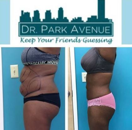 Before-and-after of a person's torso. Left side: marked for surgery. Right side: smoother profile in pink underwear.