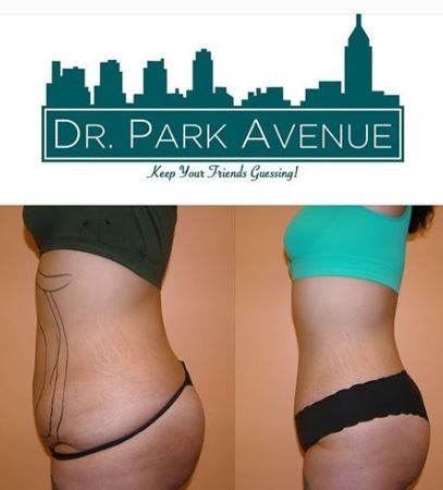 Before and after photos of a person's torso, demonstrating liposuction results.