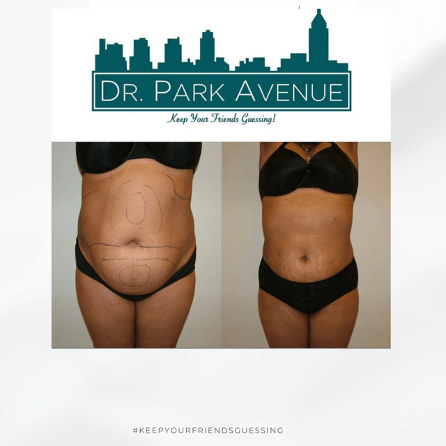 Before and after abdominal procedure photos, with surgical markings on the 