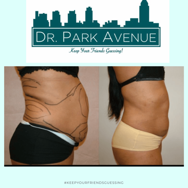 Before and after shots of a person's abdomen, showing weight loss after a cosmetic procedure.