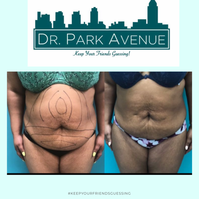 Before and after shots of abdominal area with markings before surgery.