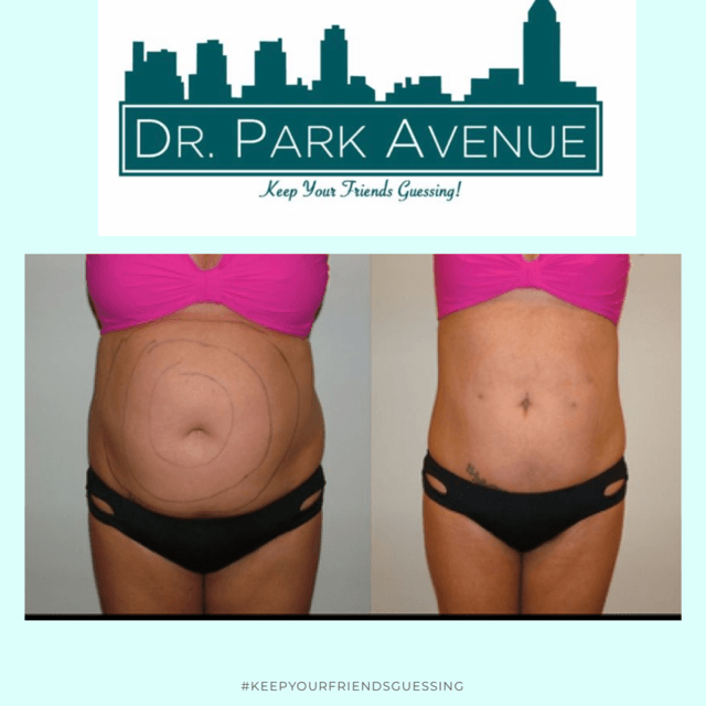 Before and after abdomen photo; marked stomach shows body contouring procedure.