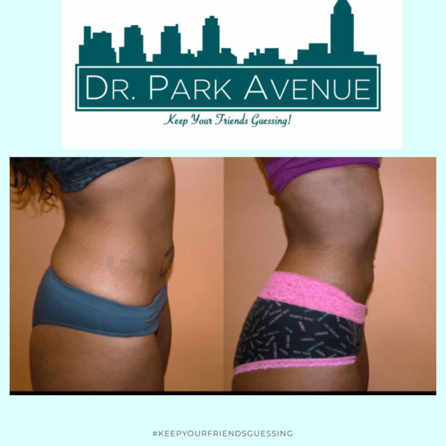 Before & after body contouring results. Woman's side profile shows a slimmer waist after the procedure.
