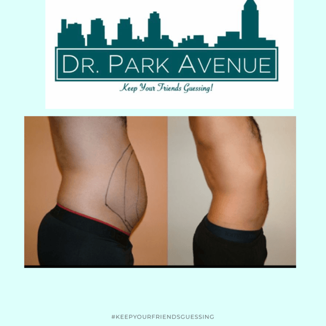 Before and after abdominal procedure photos with logo 