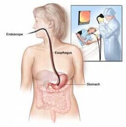 EGD Illustration — Gastroenterology Clinic in Rome, NY EGD Illustration — Gastroenterology Clinic in Rome, NY