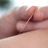 Dry Needling