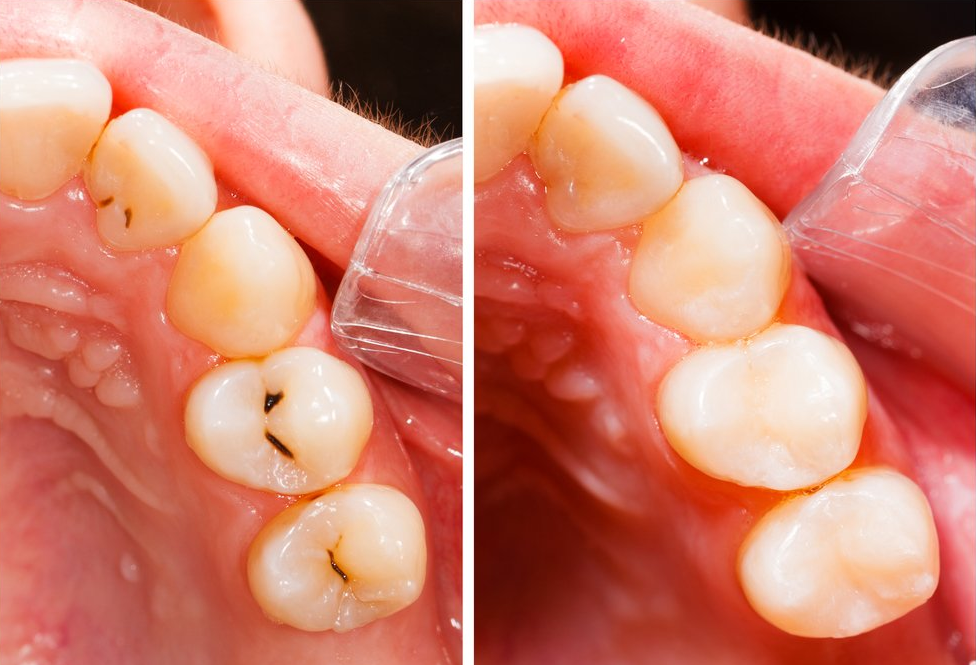 Dental Fillings