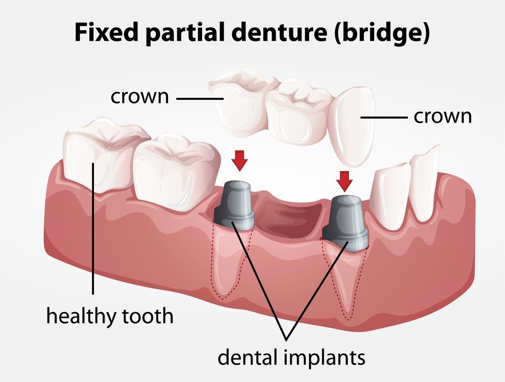 Dental Bridges