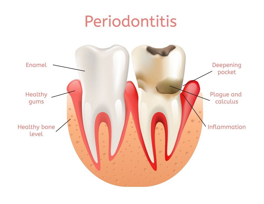 Periodontal Treatment