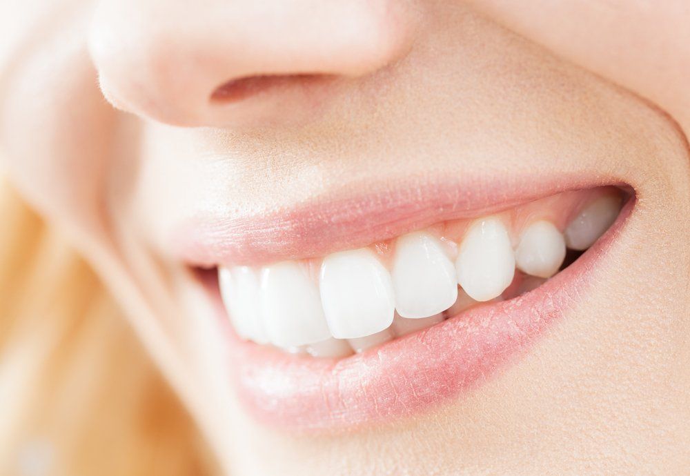 Veneers
