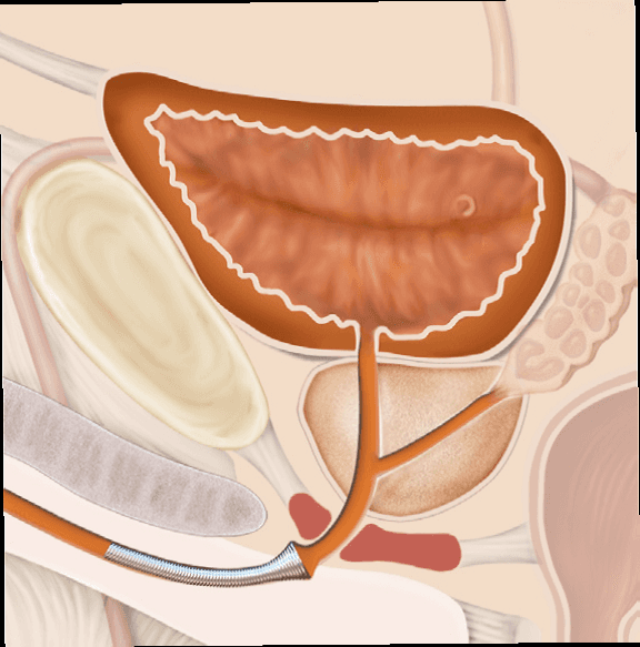 Uro gynae medical supplies in New Zealand