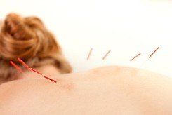 Acupuncture, Acupuncture Clinic, Pain Relief in Clearwater, FL Acupuncture, Acupuncture Clinic, Pain Relief in Clearwater, FL