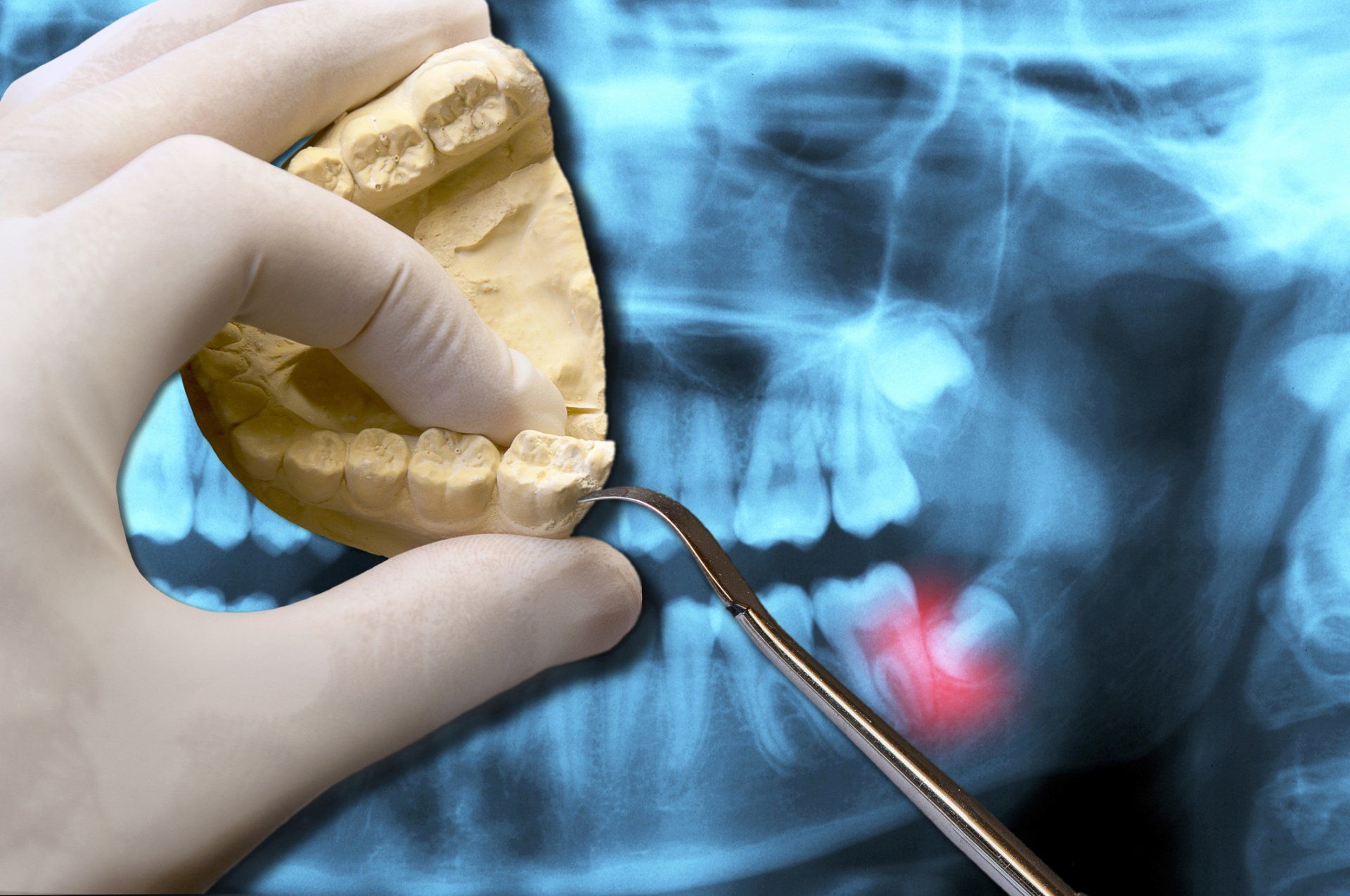 Tooth Extractions