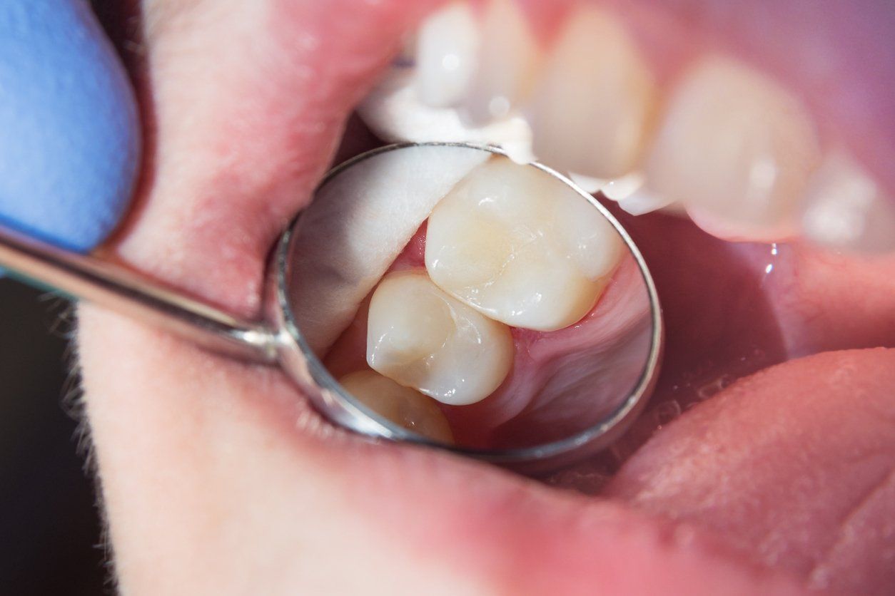 A dentist's mirror shows a close-up of teeth in a mouth, revealing fillings.