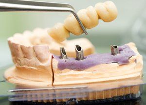 Dental bridge held by tweezers above a dental model with implant posts, demonstrating the procedure.