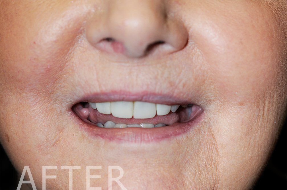 composite veneers after