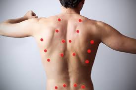 Person’s bare back with red dots marking pain points along the spine and shoulders