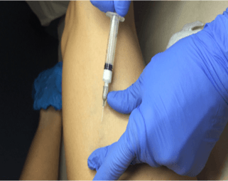 trattamento di scleroterapia tramite iniezione