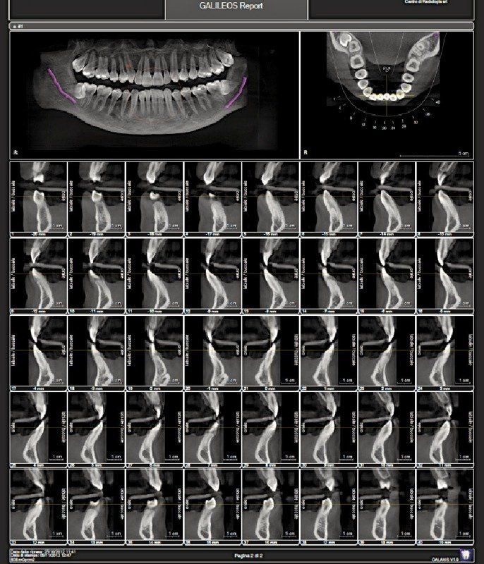 immagine diagnostica denti con dentascan