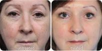 anti ageing, anti aging, skin care, youthful, skin procedures, skin analysis, youthful