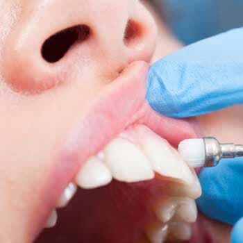 Teeth Polishing — whiter teeth in Chicago, IL Teeth Polishing — whiter teeth in Chicago, IL