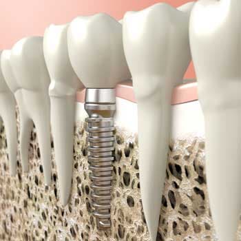 dental implants - Chicago, IL - Dr. Mary A. Starsiak dental implants - Chicago, IL - Dr. Mary A. Starsiak