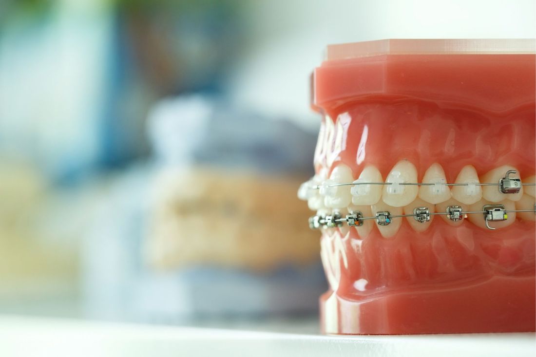 apparecchio dentistico fisso