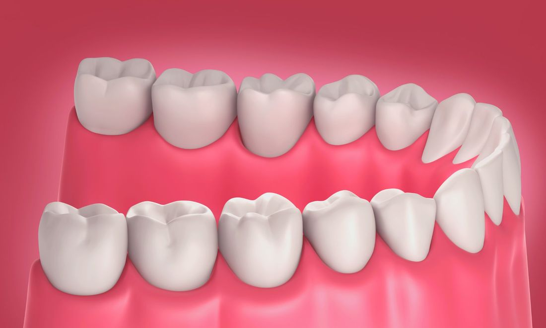 riproduzione 3d di arcata dentaria