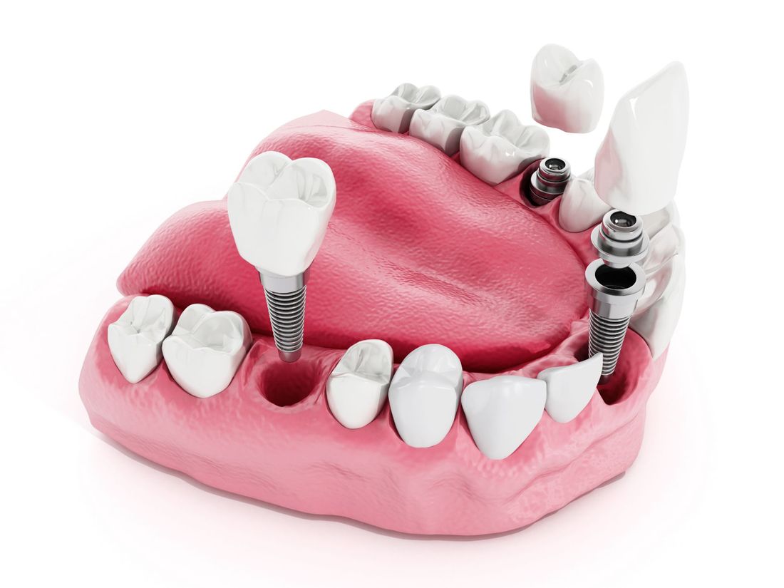 rendering di arcata dentaria con impianti