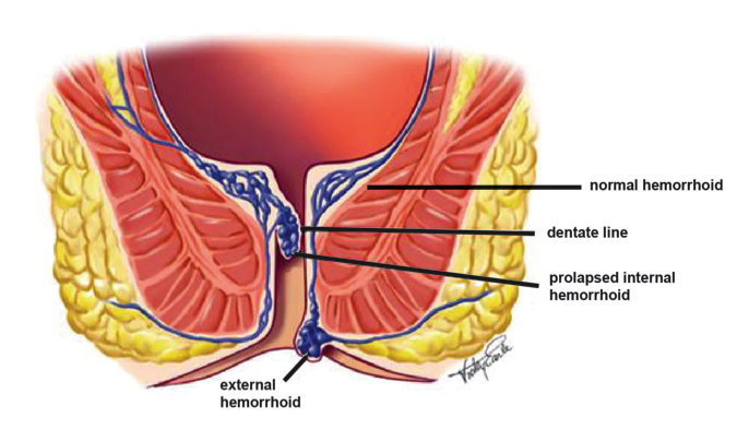 Hemorrhoid Treatment Relief