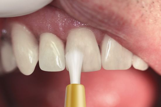 Prevora Tooth Coating