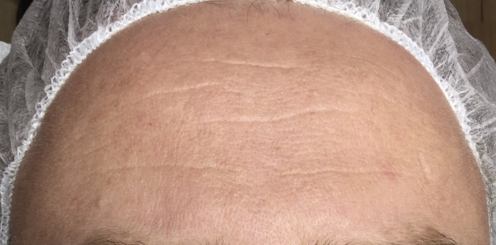 Nahaufnahme einer Stirn mit weißem Haarnetz und sichtbaren Falten