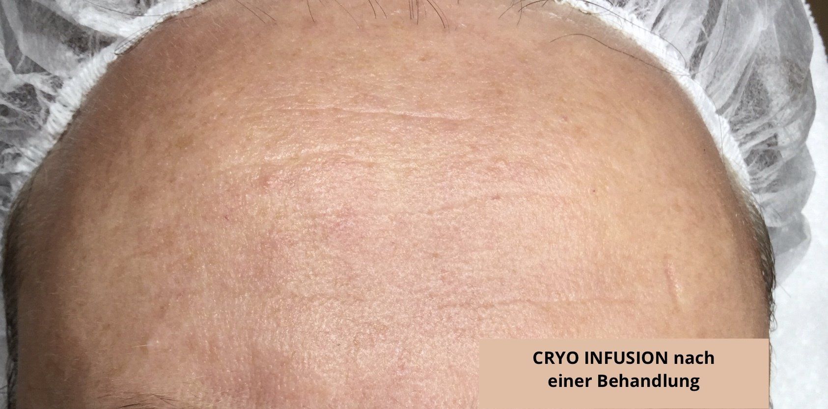 Nahaufnahme einer rasierten Kopfhaut mit einem glatten, behandelten Bereich und einem kleinen Etikett mit der Aufschrift „CRYO INFUSION“ unten rechts