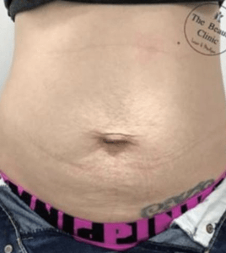 Eine Frau hat ein Tattoo auf ihrem Bauch mit der Aufschrift „Die beste Wahl“