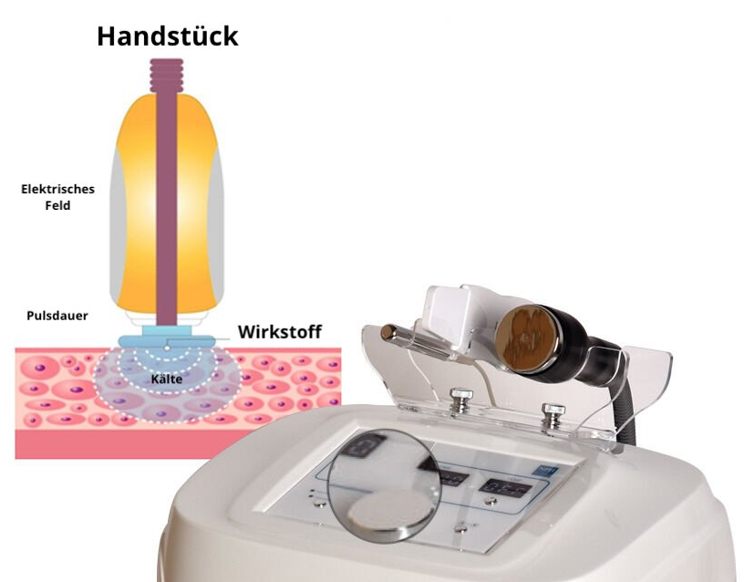 Diagramm und Foto eines handgeführten Behandlungsgeräts zur Anwendung von Licht auf die mit Gel behandelte Haut.
