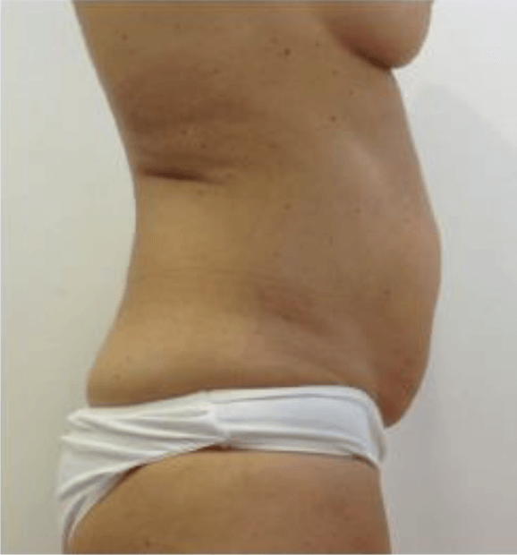 Seitenansicht eines Torsos mit hervorstehendem Bauch, der ein weißes Tuch um die Taille trägt.