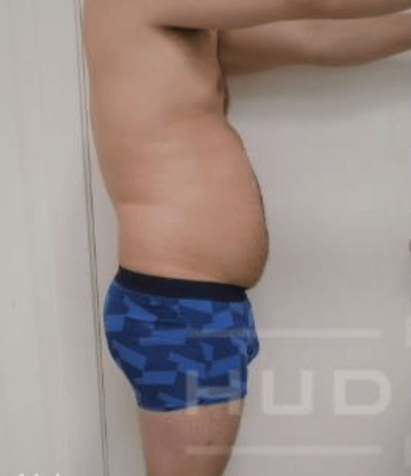 Seitenansicht des Oberkörpers einer Person in blau gemusterten Shorts vor einer schlichten Wand