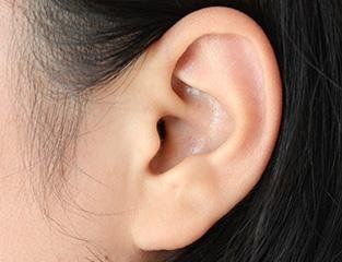 acufene tinnitus