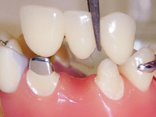 Dental bridges