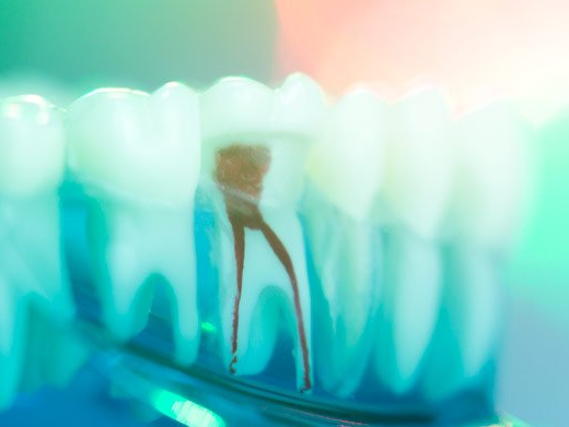 Root canal appointments