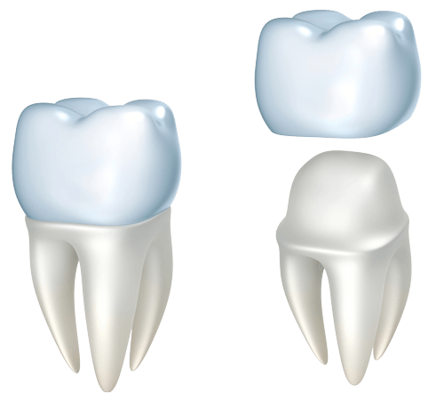 illustration of dental crown