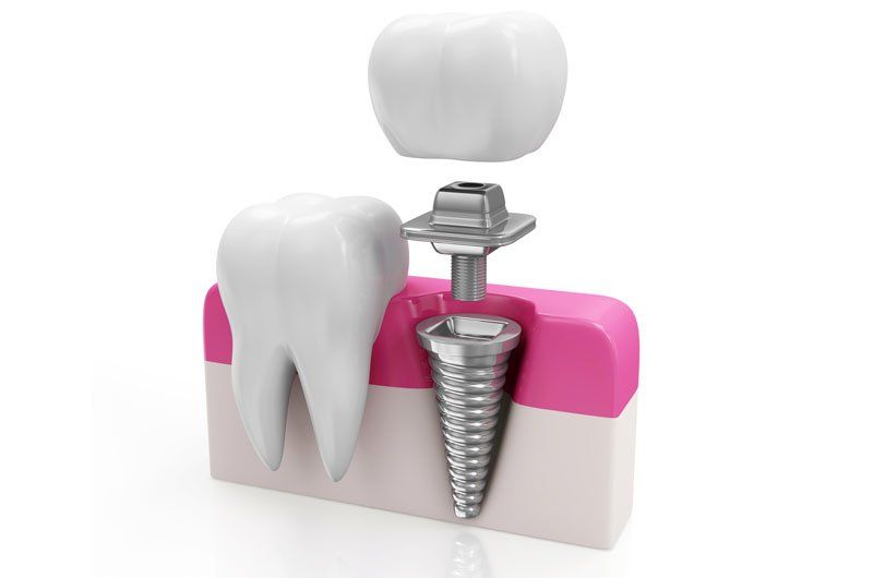 dental implant tooth implant slice section diagram