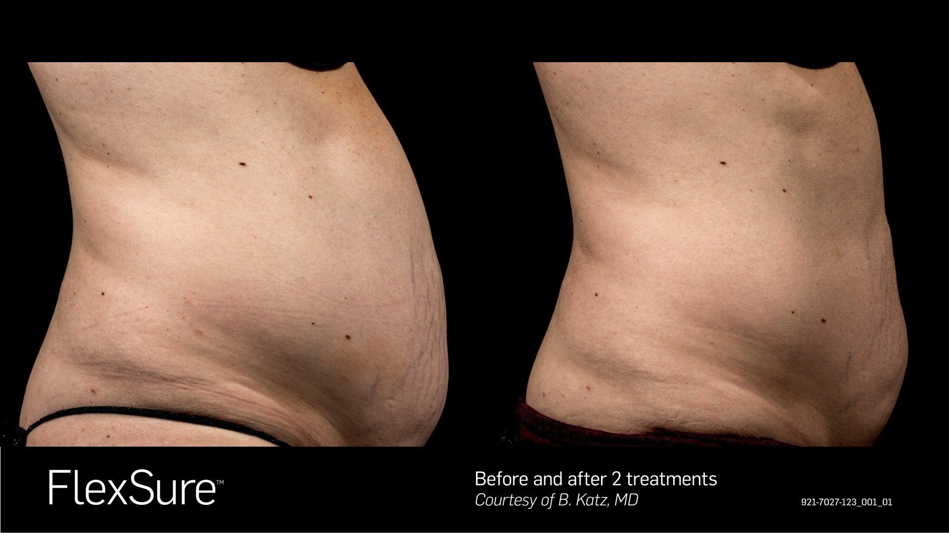 A before and after picture of a woman 's stomach with the words flexsure written on the bottom