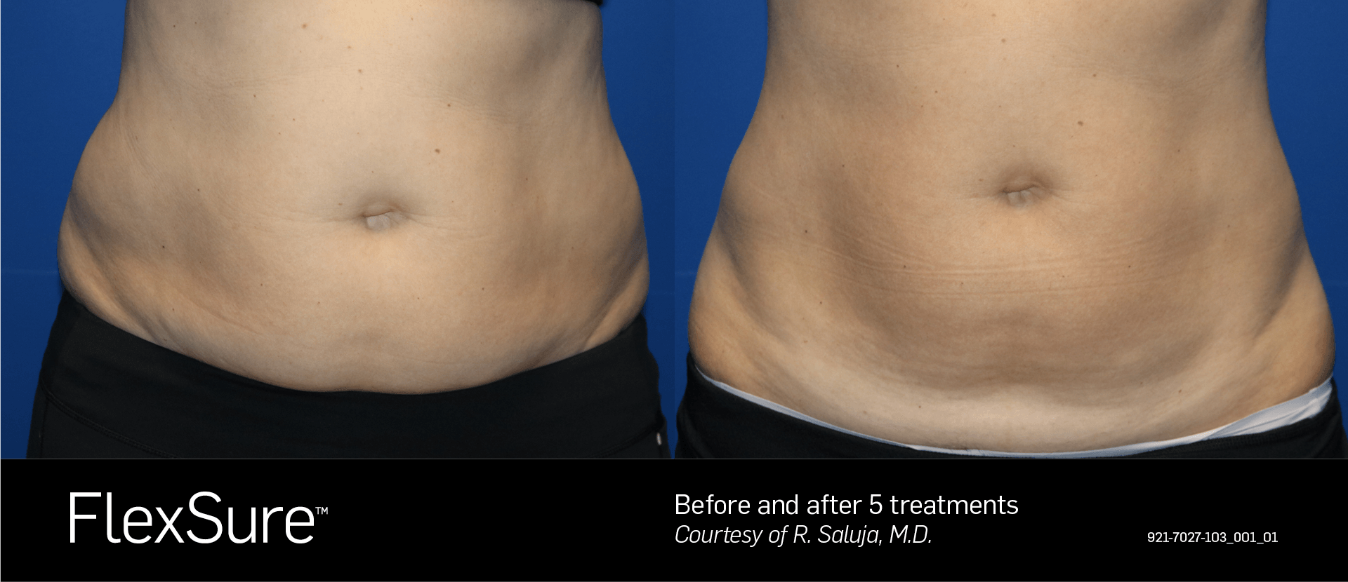 A woman 's stomach before and after a flexsure treatment