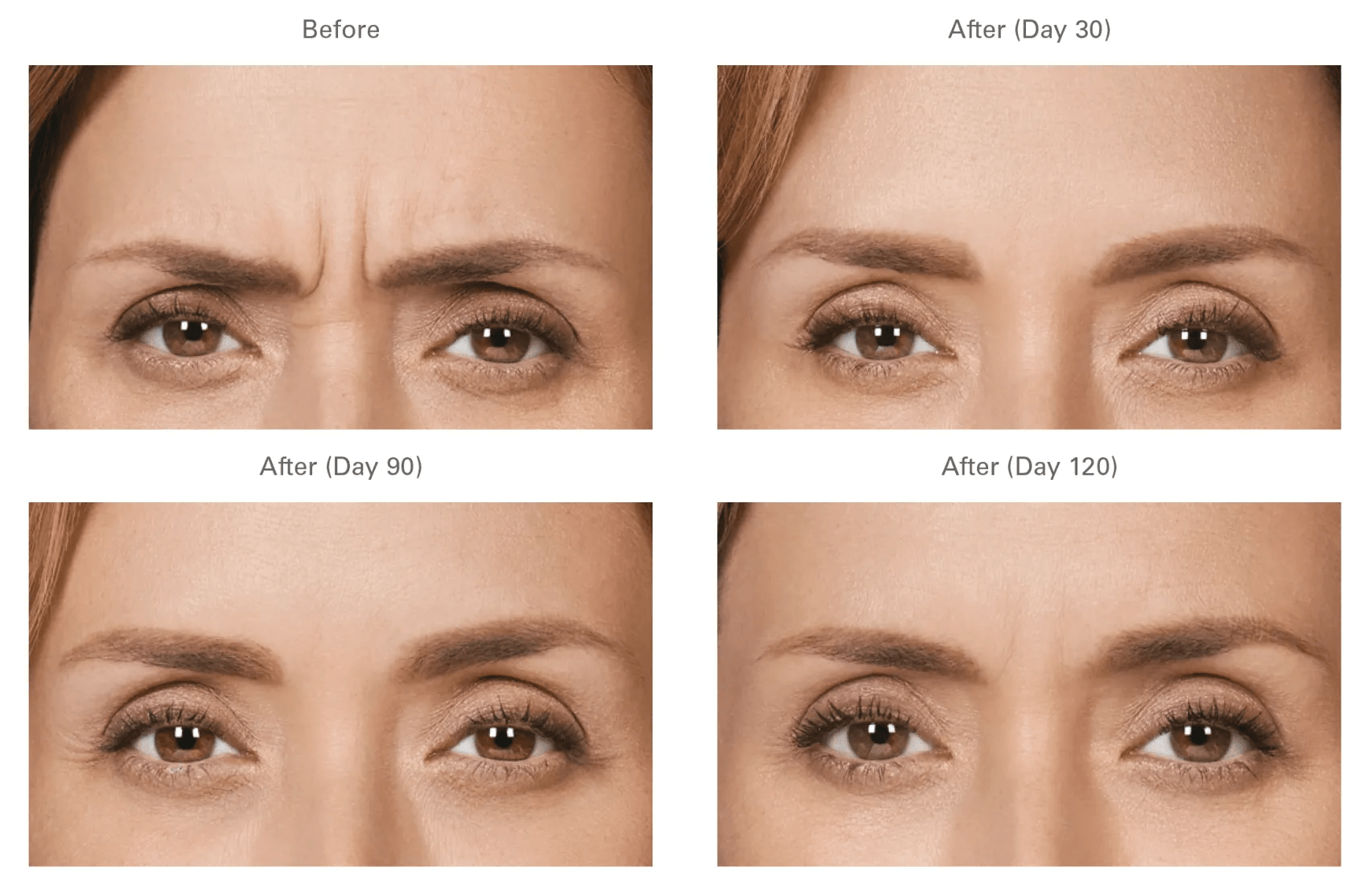 A woman 's forehead is shown before and after botox injections.