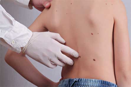 Child with rash | Murray Hill Dermatology Associates — Skin Care in New York, NY Child with rash | Murray Hill Dermatology Associates — Skin Care in New York, NY