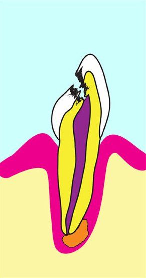 Cross-section of a tooth, showing decay, broken crown, and infection. Yellow, purple, orange, and white colors.