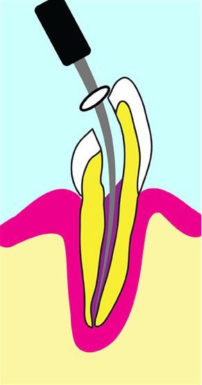 Diagram of a tooth during a root canal procedure, showing the interior canal being cleaned.